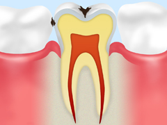 エナメル質の虫歯
