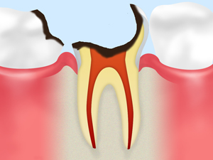 神経に達する虫歯
