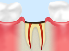歯根に達する虫歯