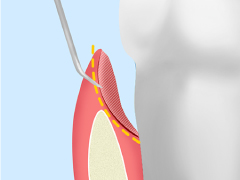 歯周ポケットそうは術