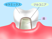 フルジルコニア